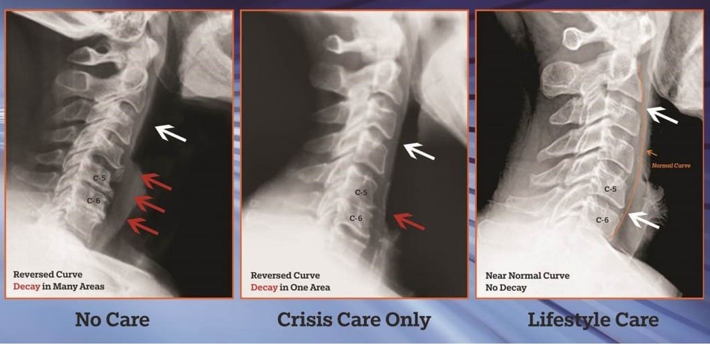 Three side-by-side neck X-rays show spine curvature: left reveals reversed curve with multiple decay points and signs of neck pain; center has reversed curve with one decay point; right shows near-normal curve and no decay. Each X-ray has colored arrows and labels neck pain relief.